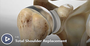photo of total shoulder replacement